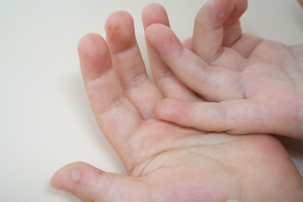 手足口病は、どういう病気？