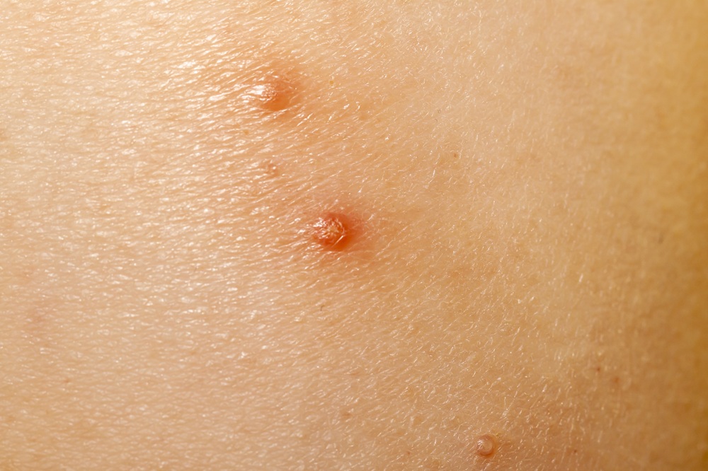 水いぼ（伝染性軟属腫）は、どういう病気？